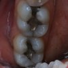 Silver Filling Replacement Before